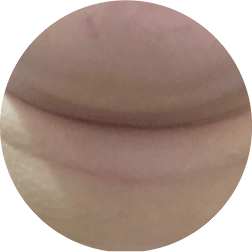 脂肪型頸紋