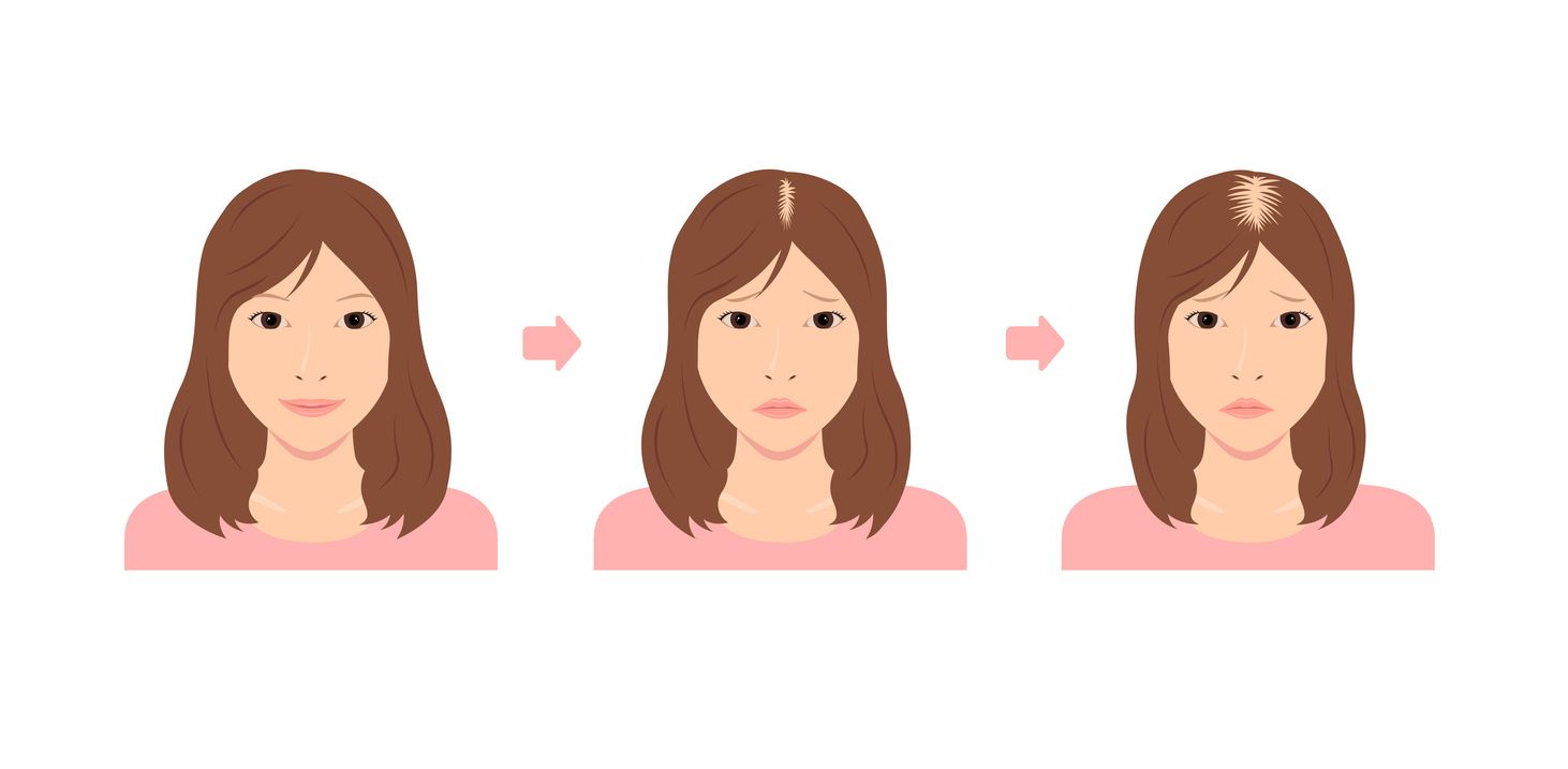 雄性禿是女性脫髮元兇？拆解6大女性雄性禿成因！必看4招自測脫髮危機+3大救髮黃金法則！