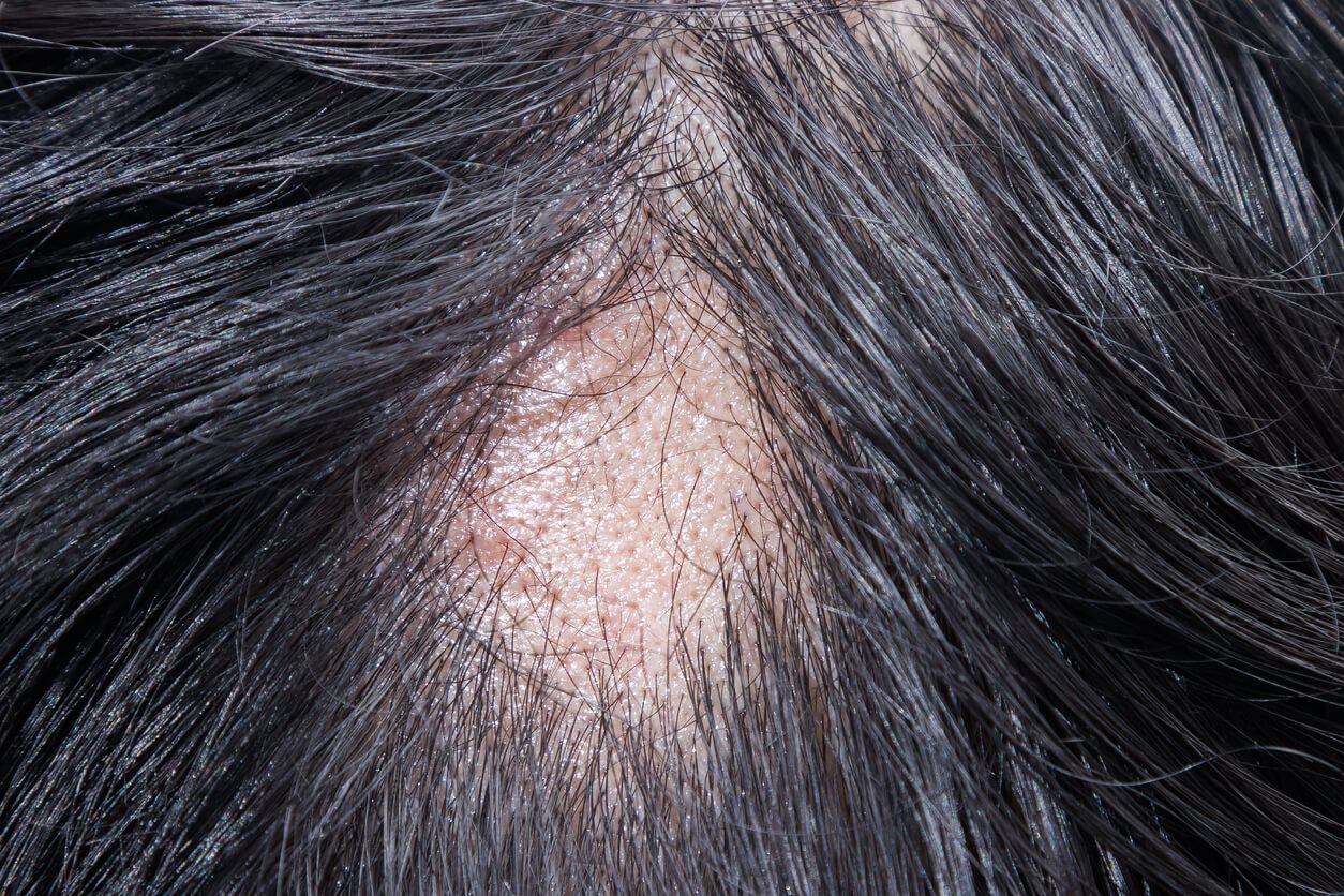 斑禿脫髮（鬼剃頭）突然找上門？拆解7大成因、先兆與療法