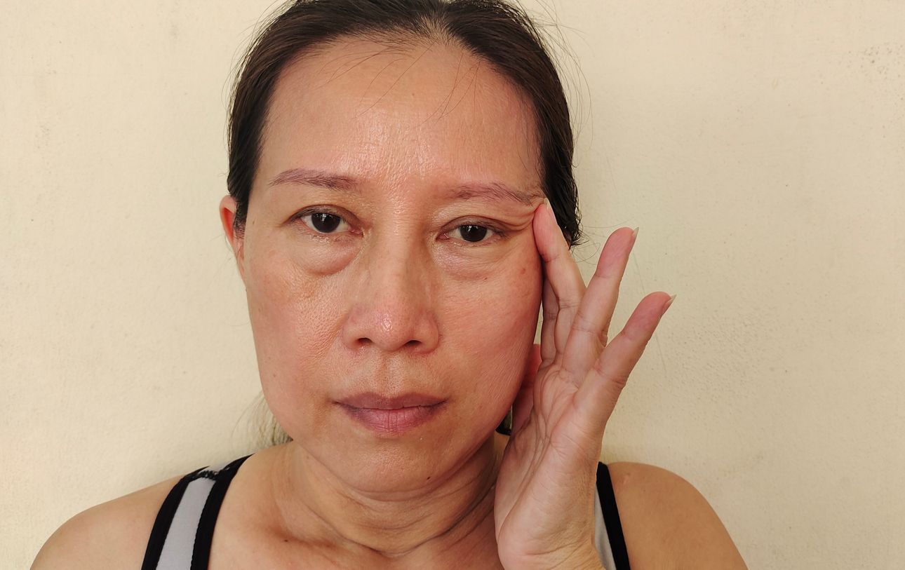 眼眶脂肪讓你顯老又顯累？揭開眼周凸出真相，5招還原平滑亮眼！ 