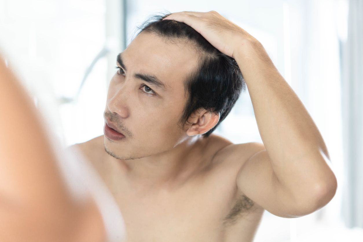 髮線後移原因全解析：6大脫髮成因＋3招判斷方法，在毛囊萎縮前救回髮際線！