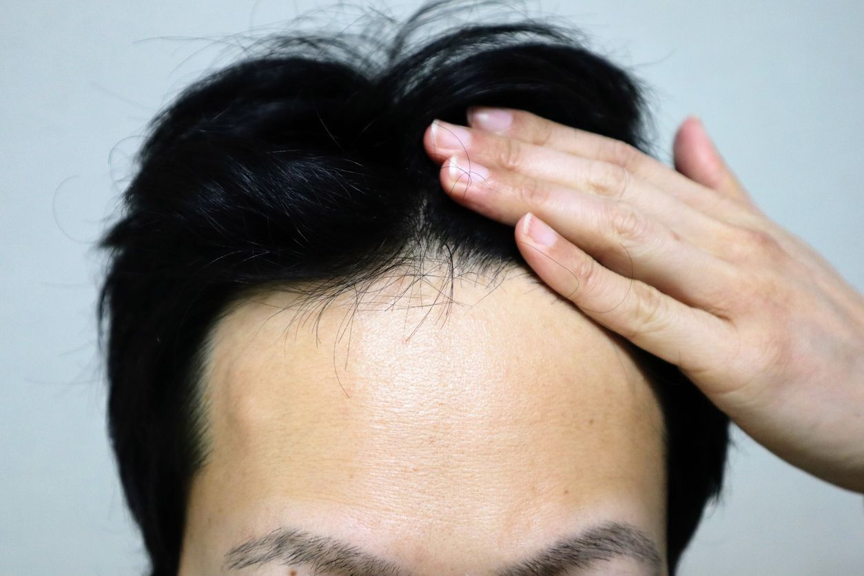 髮際線長回來真的可能嗎？解析5大生髮方向+中西醫改善方法推介 全面逆轉脫髮危機！