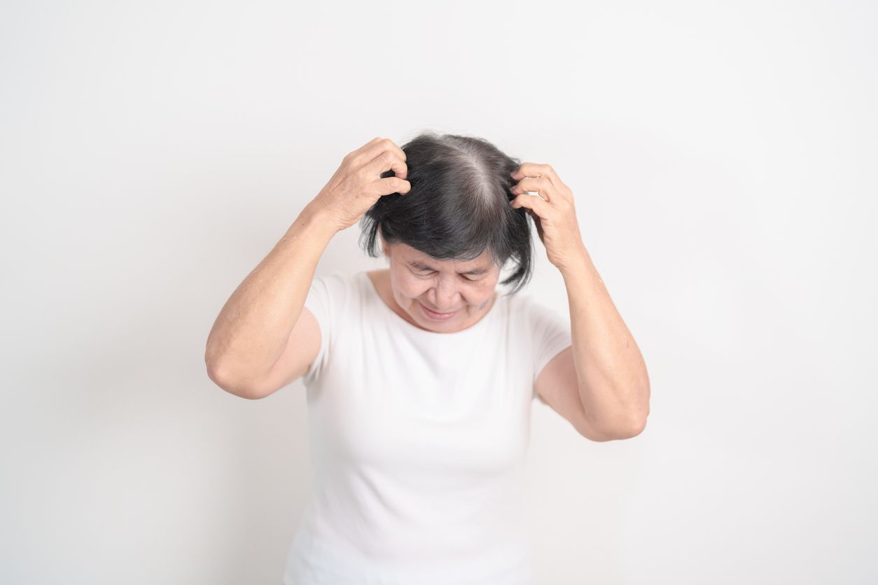 頭皮濕疹是什麼？9成人誤當頭皮屑！醫生拆解5大成因與徵兆，教你自測3大類型！