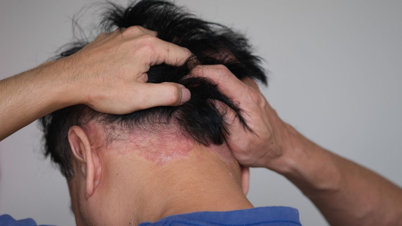 頭皮發炎治療必看：頭皮紅腫長痘是禿頭前兆？99%人不知的7個自救秘訣！