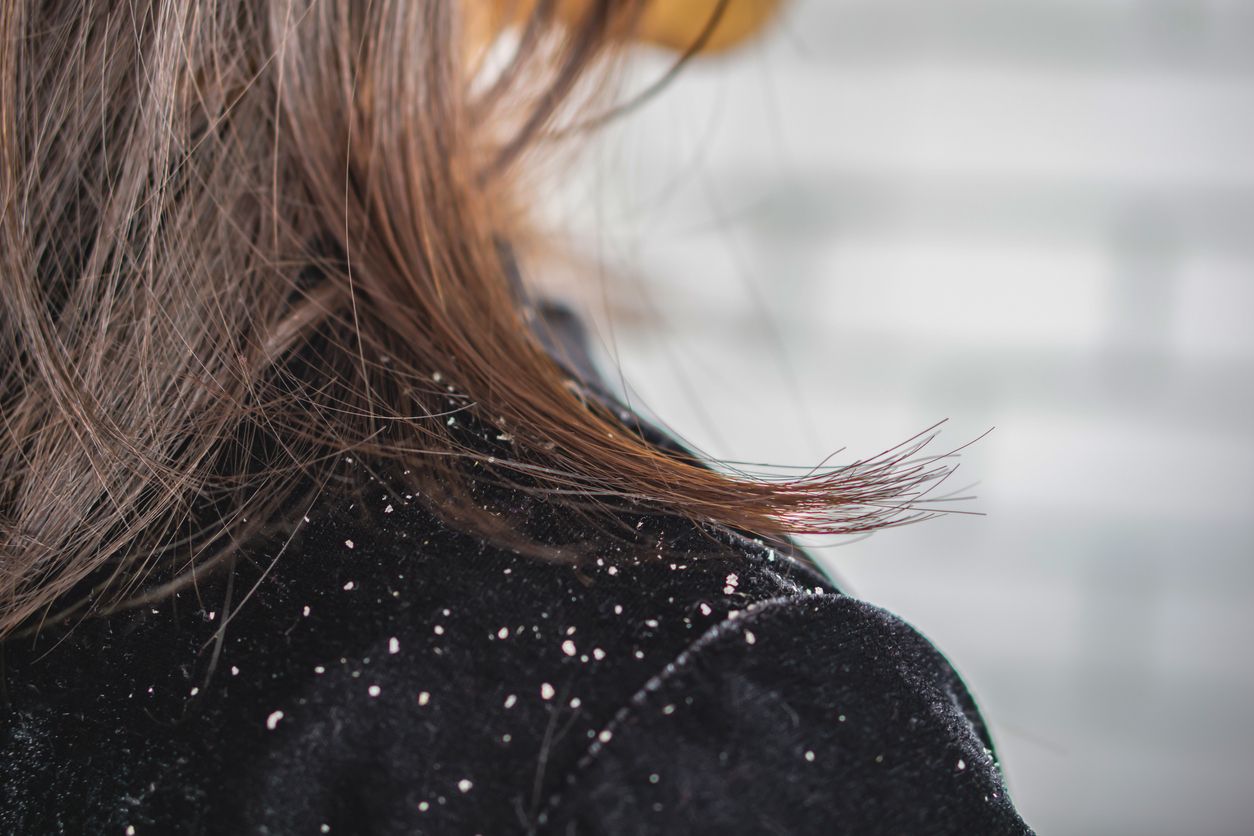 天天洗頭反而雪花滿天飛？揭開「頭皮屑多的原因」，原來這件事你一直做錯！