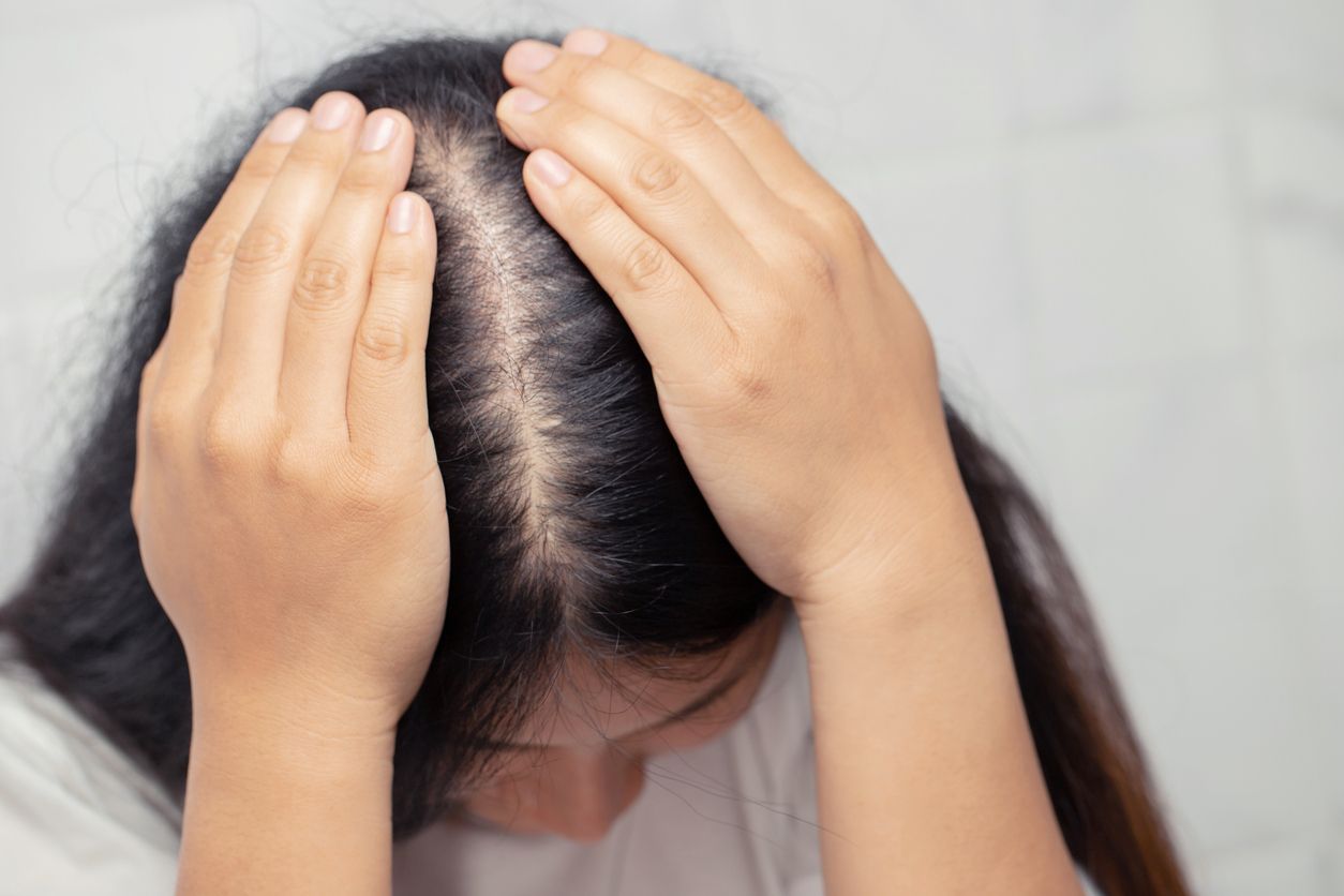 女性雄性禿懶人包：揭秘5大脫髮前兆與成因+5大改善對策 挽救後退髮際線！