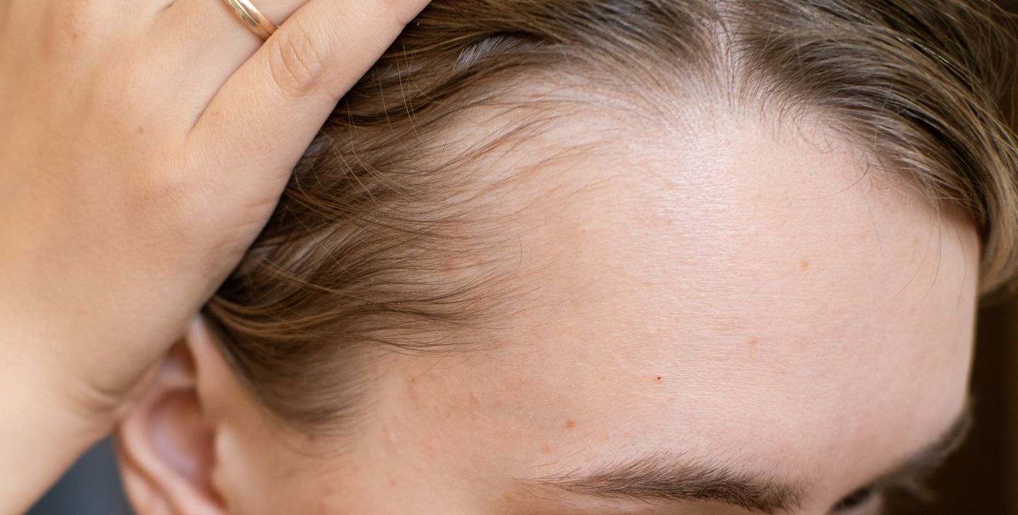 髮線向上移，年紀輕輕就開始禿？3種脫髮高危族群，你是否榜上有名？ 
