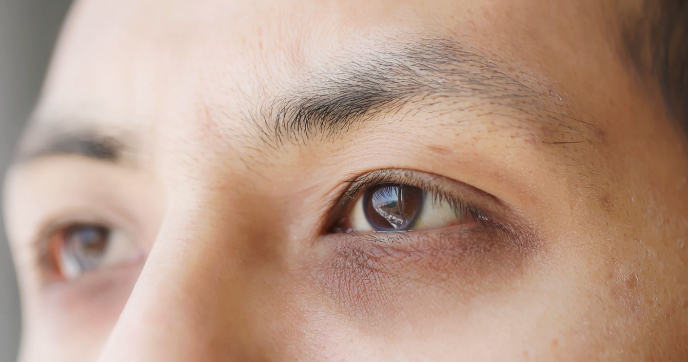 眼袋浮腫原因：5分鐘看懂眼袋浮腫原因+3招快速改善眼部水腫！