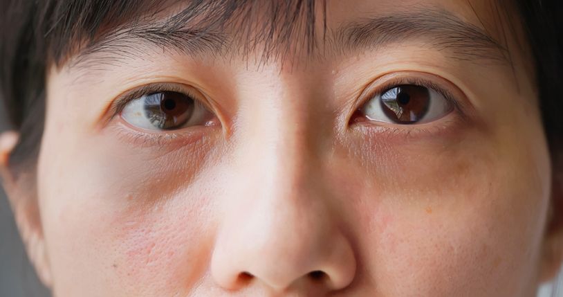 【大小眼訓練】兩星期矯正眼睛不對稱！日本5分鐘大眼操＋8大成因全解析！