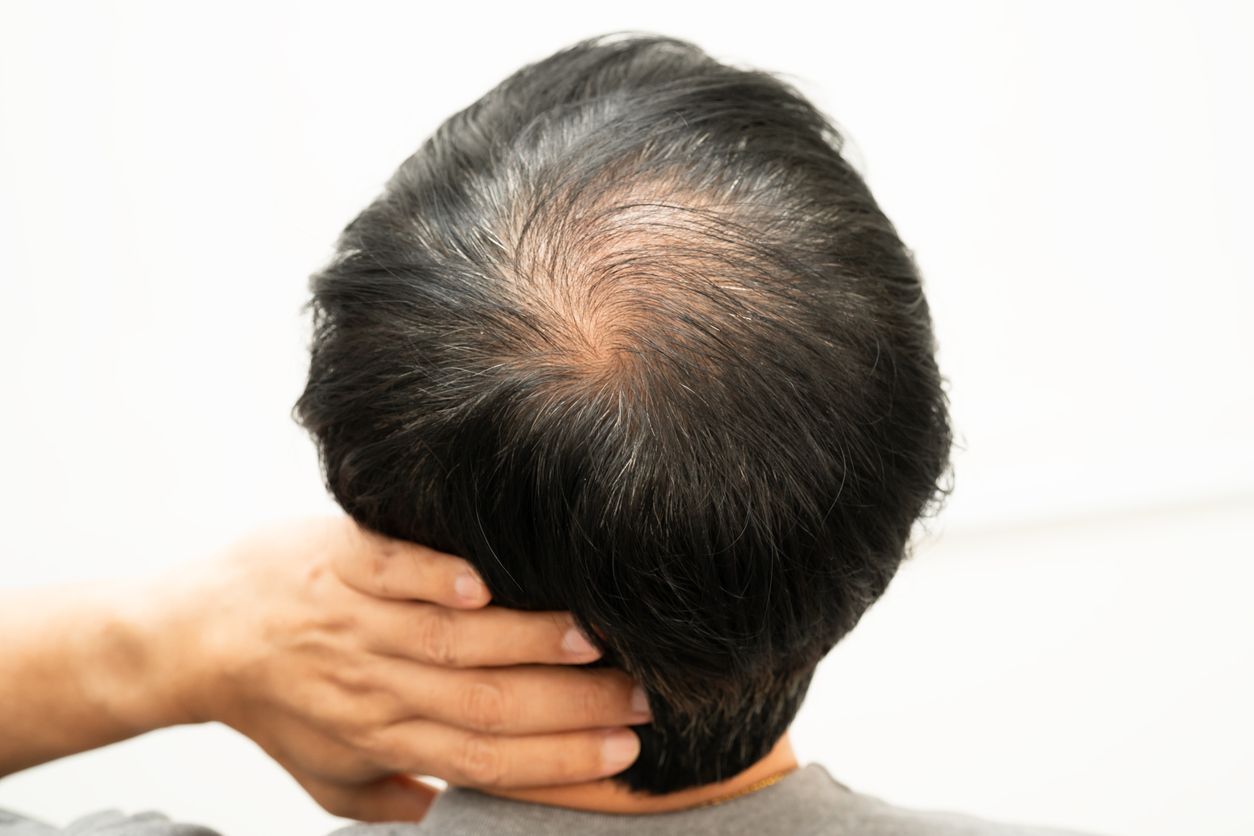 髮旋禿有救嗎？不想變「地中海」必看的5個徵兆！4大改善方法與生髮黑科技推薦 