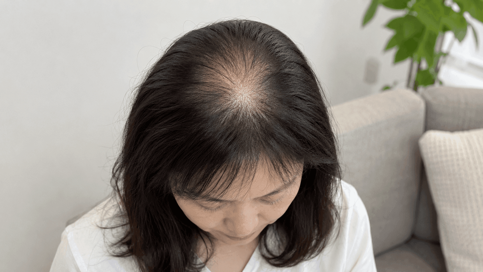地中海頭髮成因深度解析：揭秘3大掉髮元兇+專業治療方案推介 徹底告別頂部稀疏！