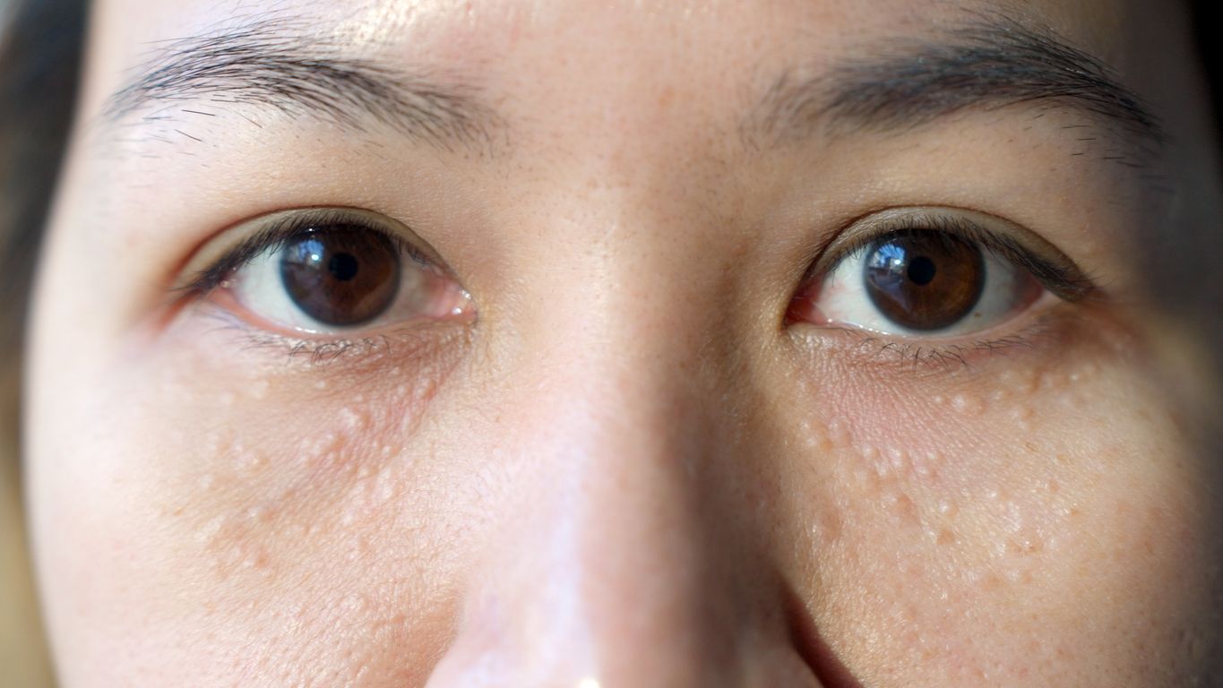 眼周油脂粒怎麼消？拆解 6 大油脂粒成因與日常盲區+5 個日常改善方法！