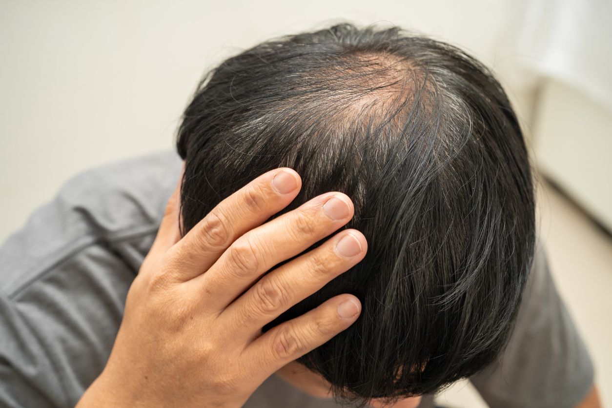 髮旋禿4大隱藏成因！醫生揭秘：必學7招預防髮旋禿秘訣 + 90%人忽略的5大前兆！