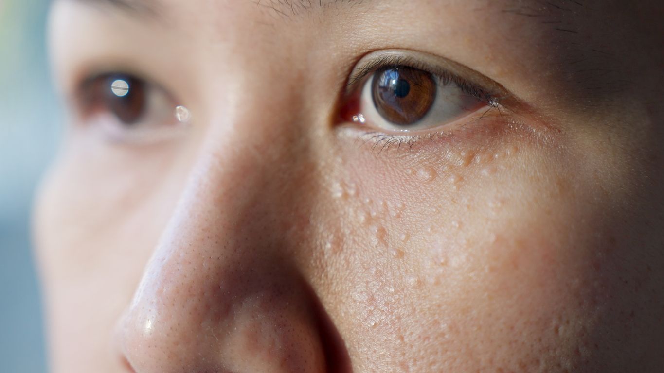 擊退脂肪粒與油脂粒！眼周白色顆粒成因、急救方法與激光治療全攻略