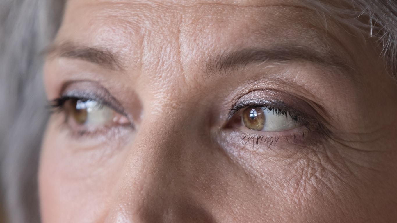 眼袋美容攻略：3大眼袋類型、成因 + 免開刀消除眼袋方法