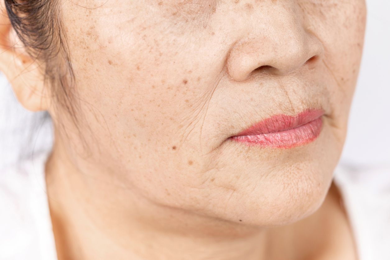 臉上長黑點只是影響外觀？醫生提醒：這幾種「斑」可能是皮膚癌前兆 