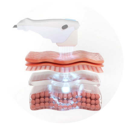 Ultherapy