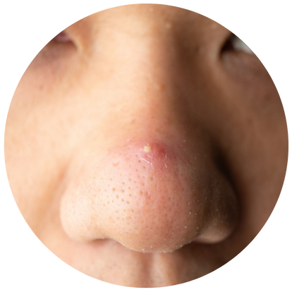 鼻頭生瘡