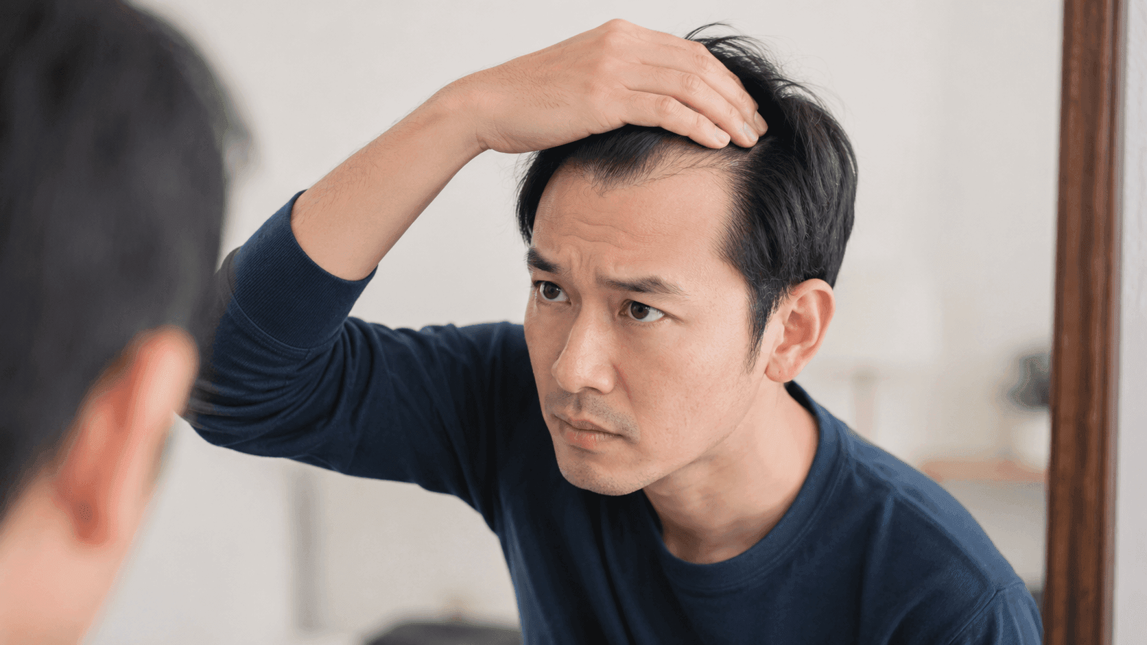 髮際線改善全攻略：解析5大後移原因+日常拯救方法推介 徹底告別高額頭！