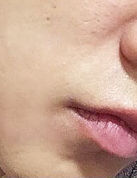 療程後