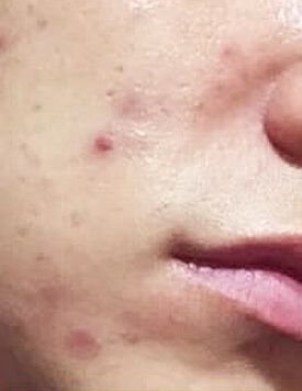 療程前