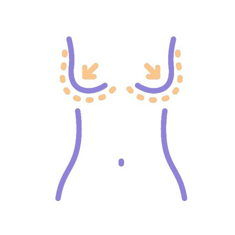 通乳腺豐胸