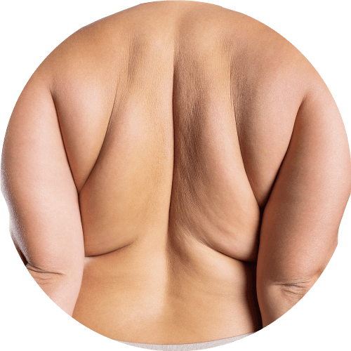 真．副乳