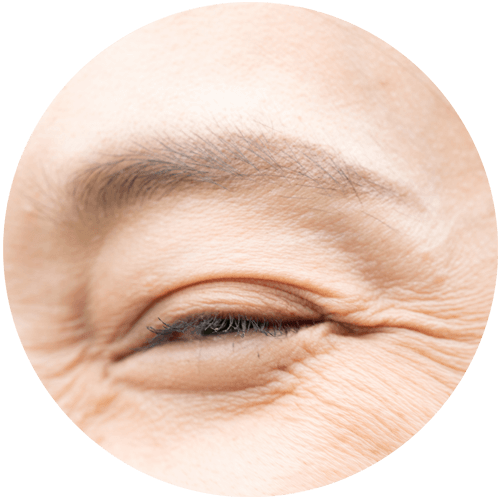 眼角紋
