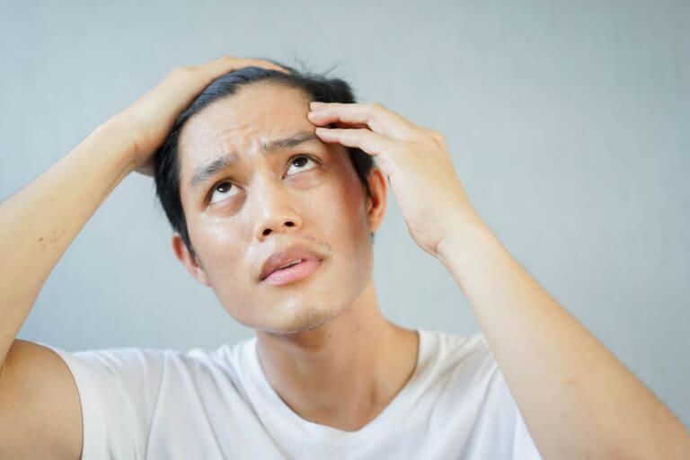 前額脫髮